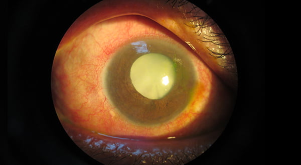 Cataract Eye