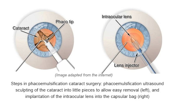 cataract-step2