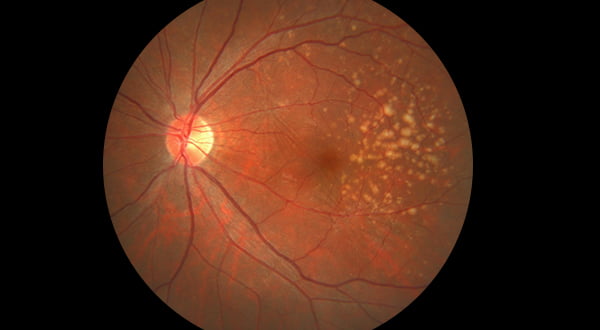 DRY AMD