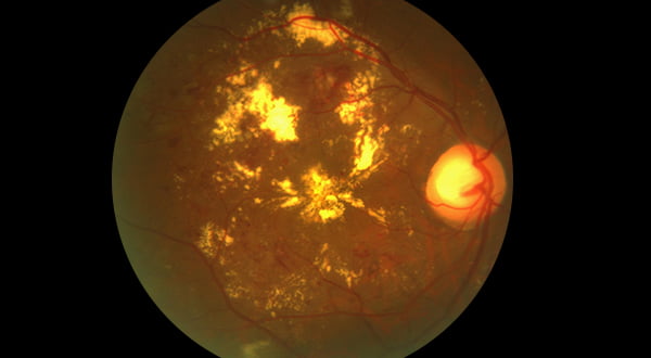 Diabetic Retinopathy