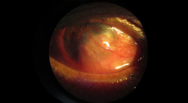 Pterygium
