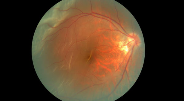 Retinal Detachment