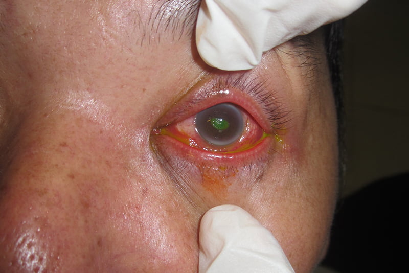 Conjunctivitis
