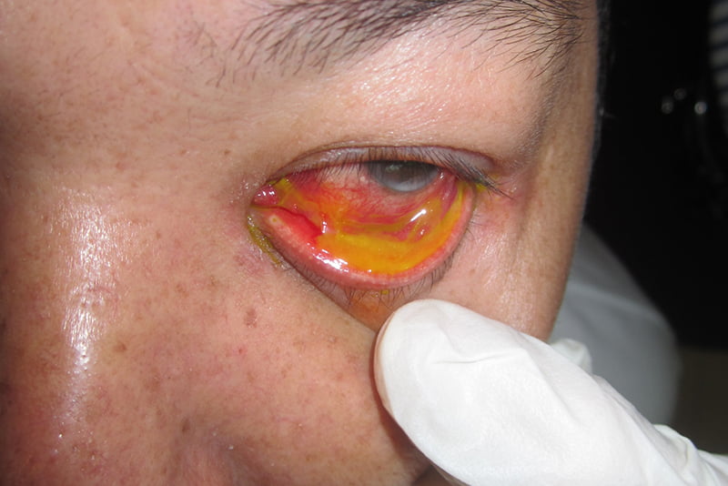 Conjunctivitis