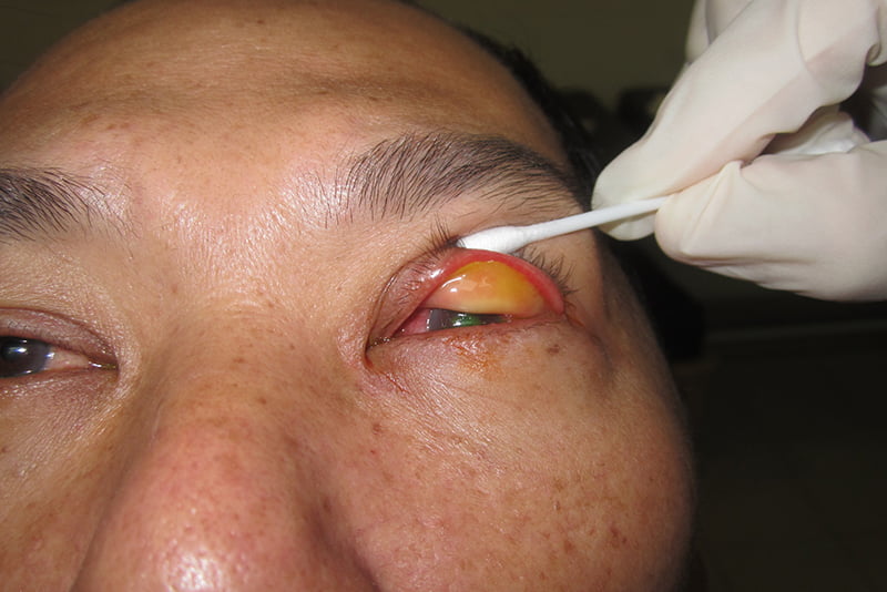 Conjunctivitis