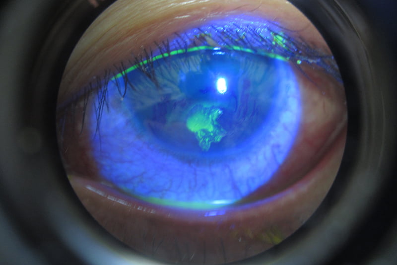 Cornea Erosion