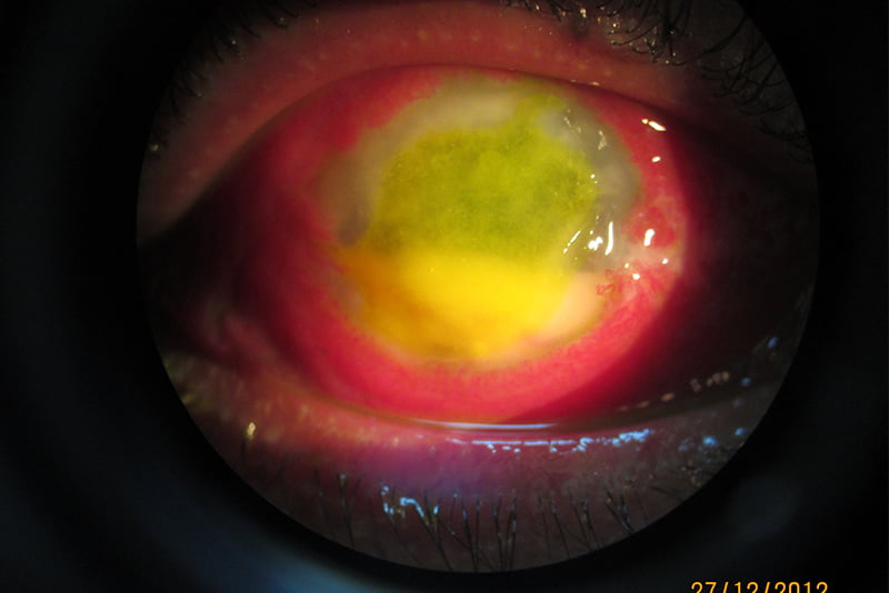 Cornea Ulcer
