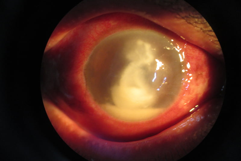 Cornea Ulcer