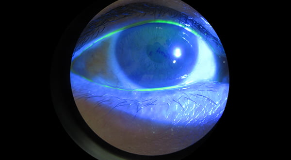 Dry Eye Tear Film Deficiency