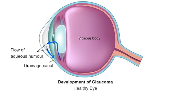 Glaucoma - 1
