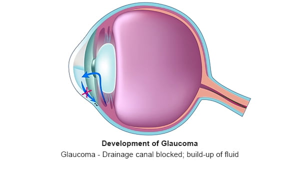Glaucoma - 2