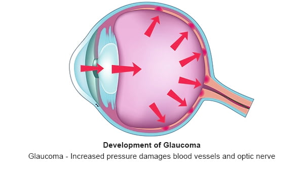 Glaucoma - 3