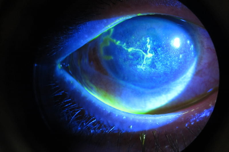 Herpetic Eye Disease