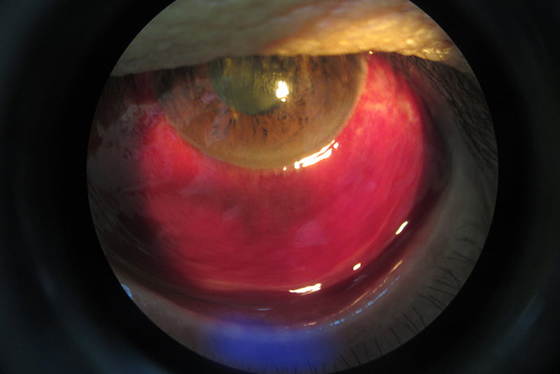 Subconjunctival Hemorrhage