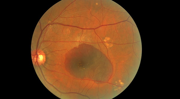 WET AMD