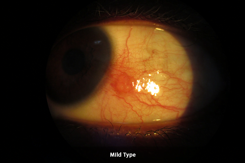 Pingucuelitis - mild type