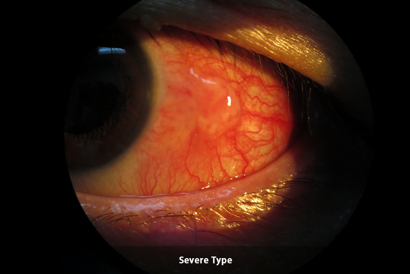 Pingucuelitis - severe type