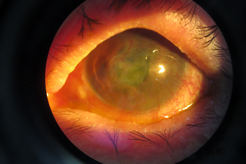 Steven Johnson Syndrome 1