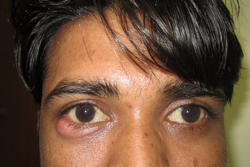 Stye-Chalazion 3