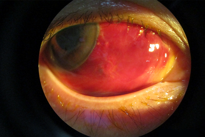 Subconjunctival Hemorrhage 1