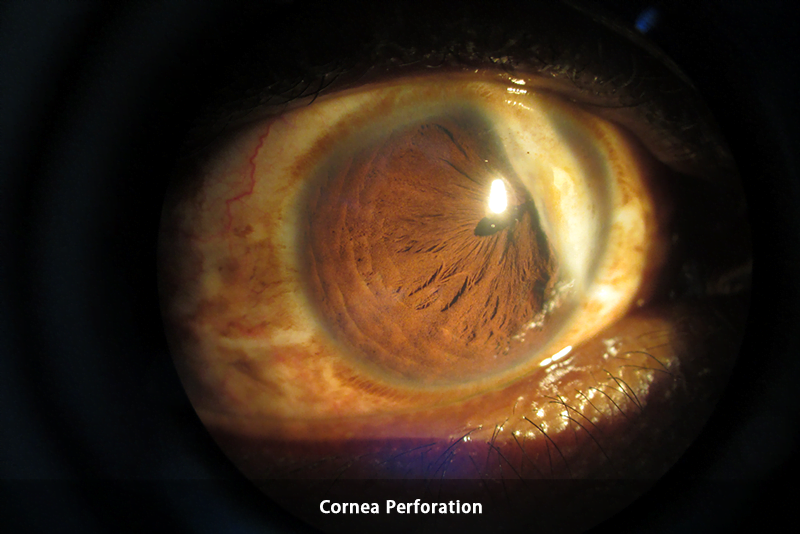 Trauma - Cornea Perforation