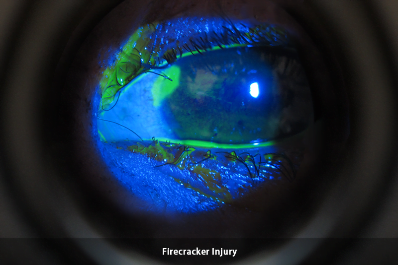 Trauma - Firecracker - new