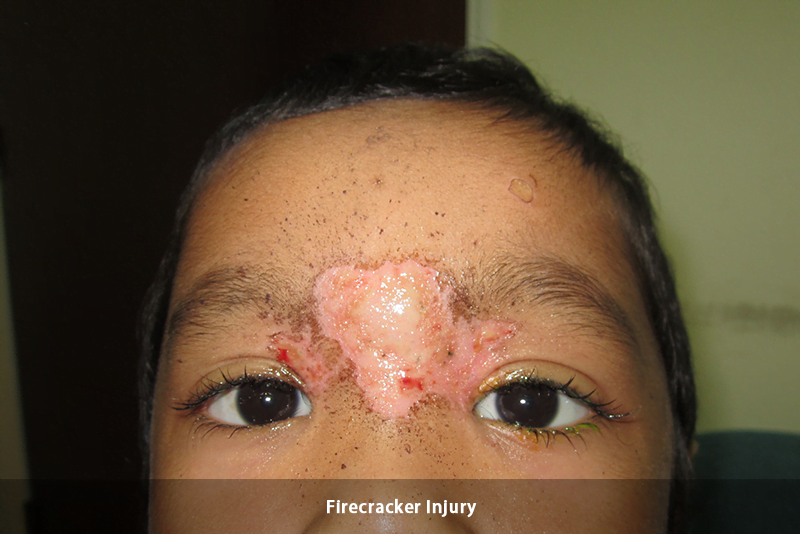 Trauma - Firecracker1