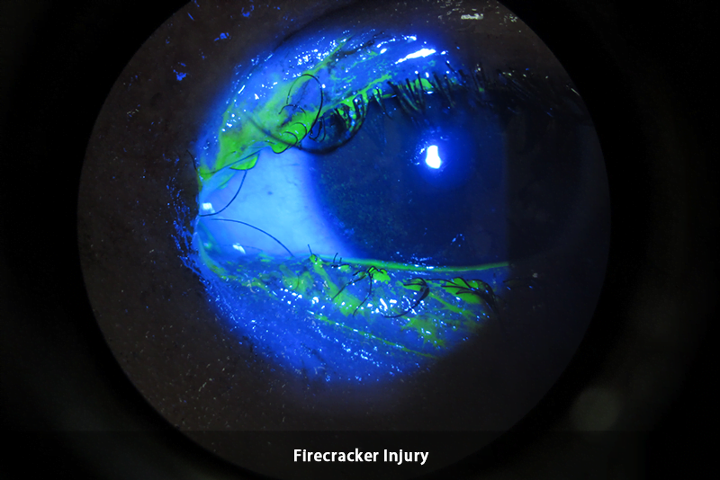 Trauma - Firecracker2