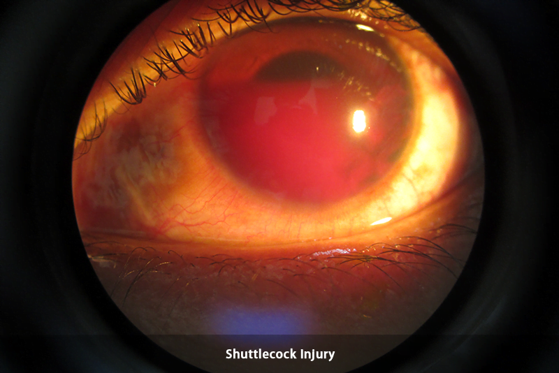 Trauma - ShuttleCock